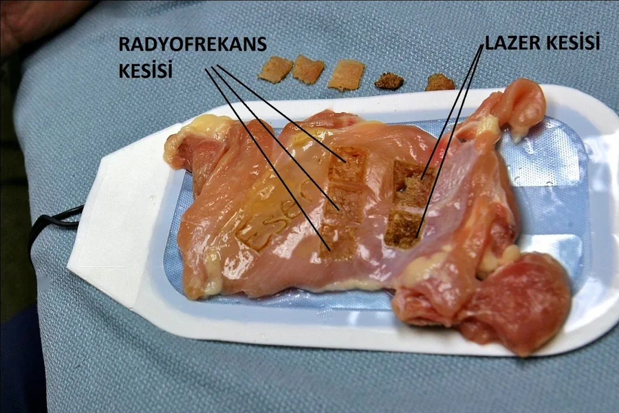 Radyofrekans labioplasti cihazı ile kesim