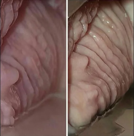 Vajina daraltma öncesi ve sonrası